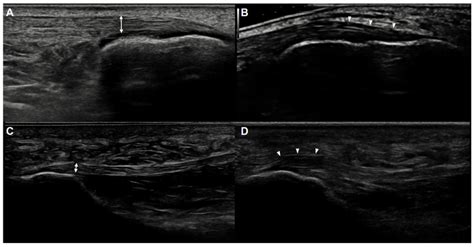 Ultrasonographic Study of Achilles Tendon and Plantar 